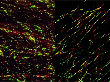 En la imagen de la izquierda se ve las lineas celulares con las proteínas alteradas que se reproducen de forma descontrolada. En la de la derecha, una vez restablecido el orden En la imagen de la izquierda se ve las lineas celulares con las proteínas alteradas que se reproducen de forma descontrolada. En la de la derecha, una vez restablecido el orden