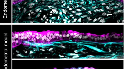 Similitud del nuevo modelo endometrial (dos imágenes inferiores) con una biopsia de tejido endometrial (imagen superior) Similitud del nuevo modelo endometrial (dos imágenes inferiores) con una biopsia de tejido endometrial (imagen superior)