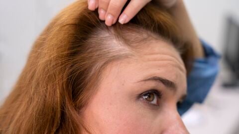 Mujer que sufre de caída de pelo