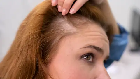 Mujer que sufre de caída de pelo Mujer que sufre de caída de pelo
