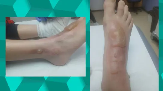 Un menor de 12 años secuestra, tortura y quema a un compañero de clase en Los Barrios Un menor de 12 años secuestra, tortura y quema a un compañero de clase en Los Barrios