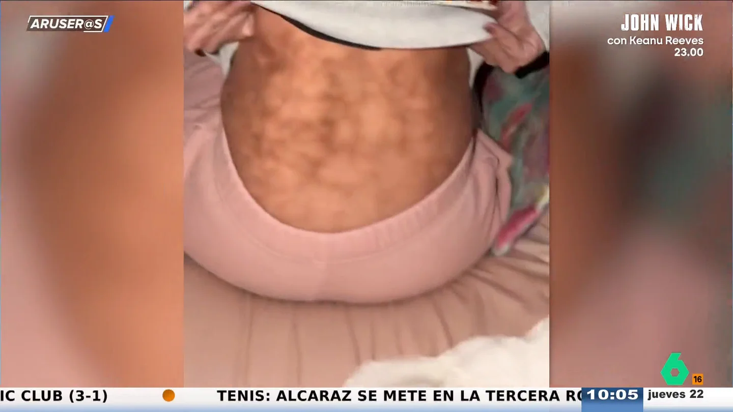 Los riesgos de dormir cada noche con la manta eléctrica: una mujer muestra las consecuencias Los riesgos de dormir cada noche con la manta eléctrica: una mujer muestra las consecuencias