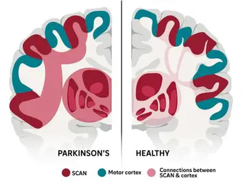 Diferencias entre un cerebro sano y otro con Parkinson Diferencias entre un cerebro sano y otro con Parkinson