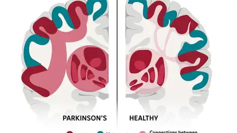 Diferencias entre un cerebro sano y otro con Parkinson Diferencias entre un cerebro sano y otro con Parkinson