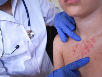 Niño con sarampión Niño con sarampión