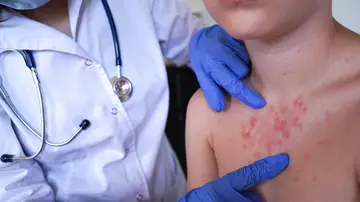 Niño con sarampión Niño con sarampión