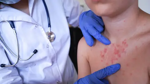 Niño con sarampión Niño con sarampión