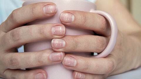 Uñas quebradizas