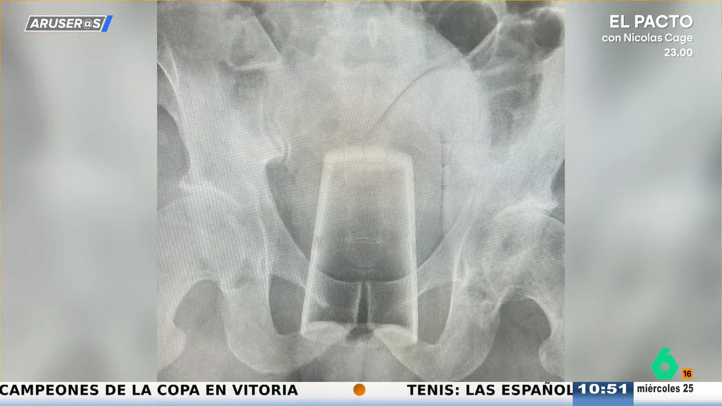 Alfonso Arús reacciona al "resbalón" del hombre que acabó con un vaso en el recto Alfonso Arús reacciona al "resbalón" del hombre que acabó con un vaso en el recto