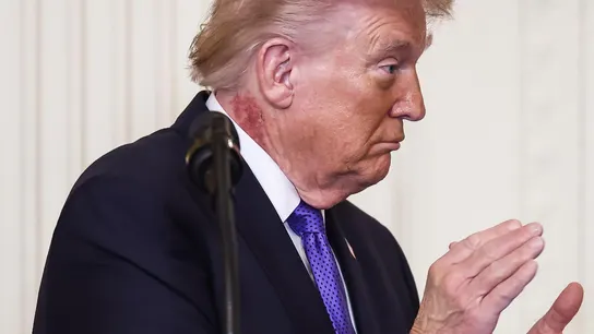 Trump luce un sarpullido en el cuello Trump luce un sarpullido en el cuello