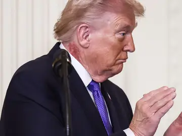 Trump luce un sarpullido en el cuello Trump luce un sarpullido en el cuello