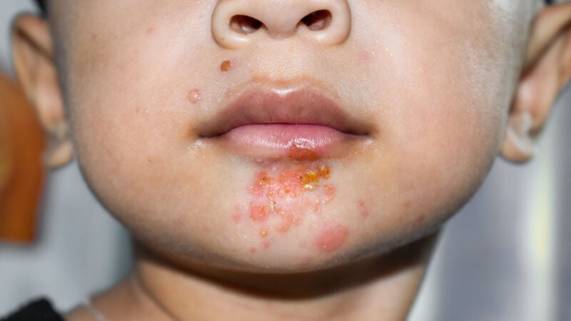Qué es el impétigo, la infección cutánea muy contagiosa que afecta especialmente a niños