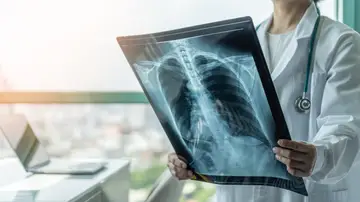 Radiografía de tórax Radiografía de tórax