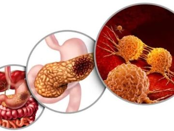 Esquema del c&aacute;ncer de p&aacute;ncreas y de los inhibidores duales