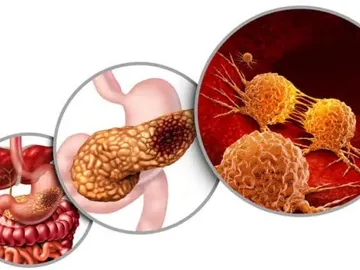 Esquema del cáncer de páncreas y de los inhibidores duales Esquema del cáncer de páncreas y de los inhibidores duales