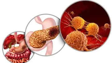 Esquema del cáncer de páncreas y de los inhibidores duales Esquema del cáncer de páncreas y de los inhibidores duales
