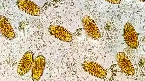 Enterobius vermicularis Enterobius vermicularis