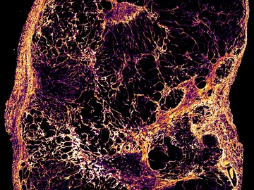 Imagen microscópica de un tumor de cáncer de mama Imagen microscópica de un tumor de cáncer de mama