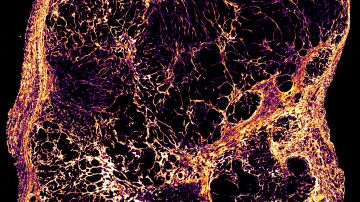 Imagen microsc&oacute;pica de un tumor de c&aacute;ncer de mama