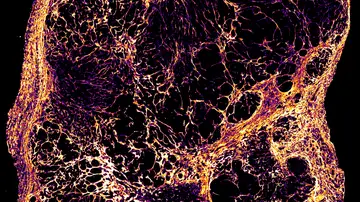 Imagen microscópica de un tumor de cáncer de mama Imagen microscópica de un tumor de cáncer de mama