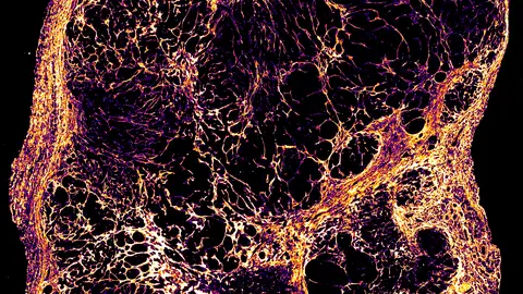 Imagen microscópica de un tumor de cáncer de mama Imagen microscópica de un tumor de cáncer de mama