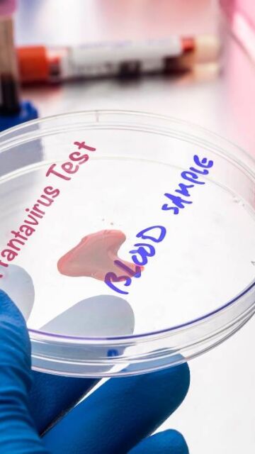 Hantavirus