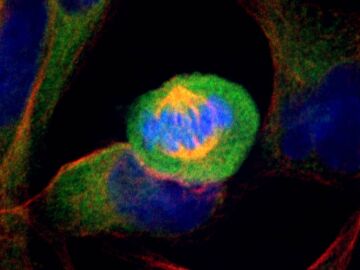 C&eacute;lulas de c&aacute;ncer de p&aacute;ncreas humano en divisi&oacute;n