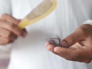 Caída del pelo Caída del pelo