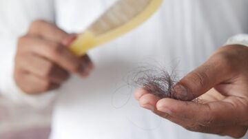 Ca&iacute;da del pelo
