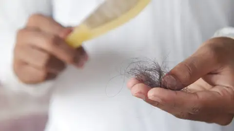 Caída del pelo Caída del pelo