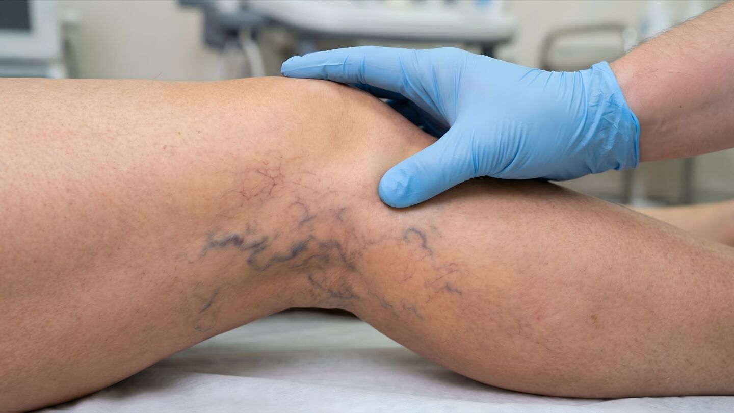 Piernas con varices