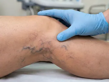 Piernas con varices Piernas con varices