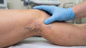 Piernas con varices