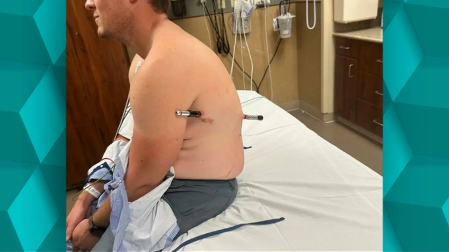 Un senderista sobrevive tras quedar empalado por su bastón de montaña y caminar seis horas herido. Un senderista sobrevive tras quedar empalado por su bastón de montaña y caminar seis horas herido.