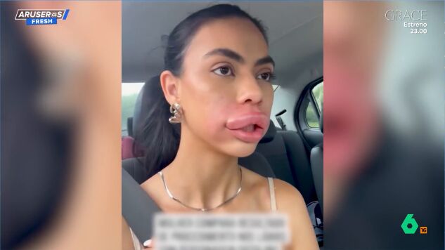 As&iacute; se le ha quedado la boca a esta chica tras inyectarse &aacute;cido hialur&oacute;nico: "Ella se compara con el pato Donald"