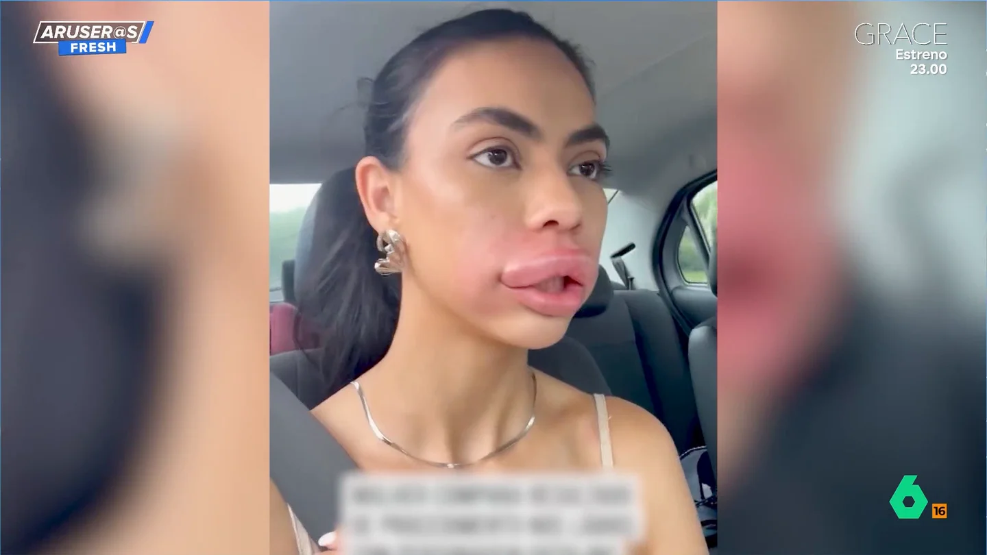 Así se le ha quedado la boca a esta chica tras inyectarse ácido hialurónico: "Ella se compara con el pato Donald" Así se le ha quedado la boca a esta chica tras inyectarse ácido hialurónico: "Ella se compara con el pato Donald"
