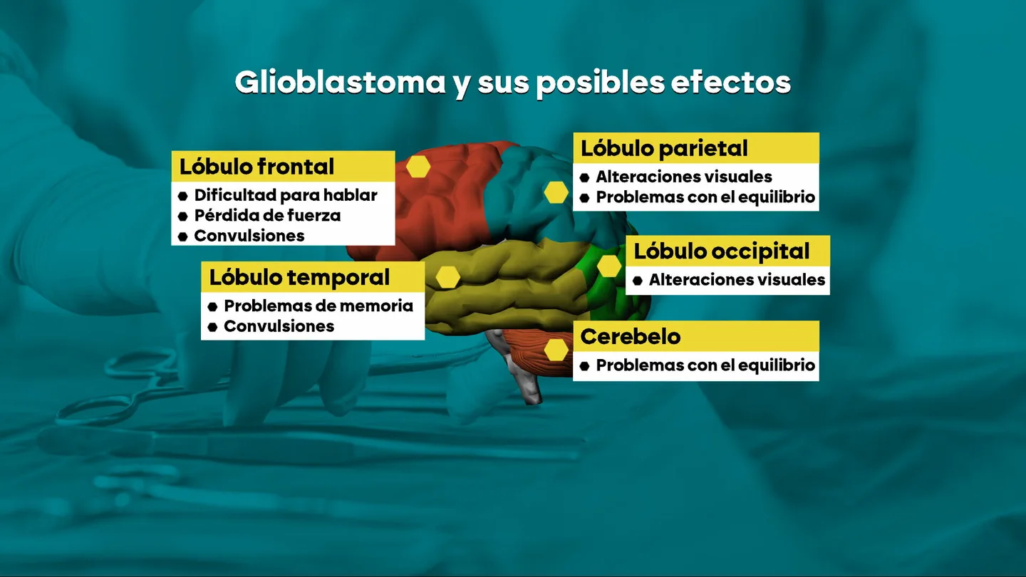 Gliobastoma Gliobastoma