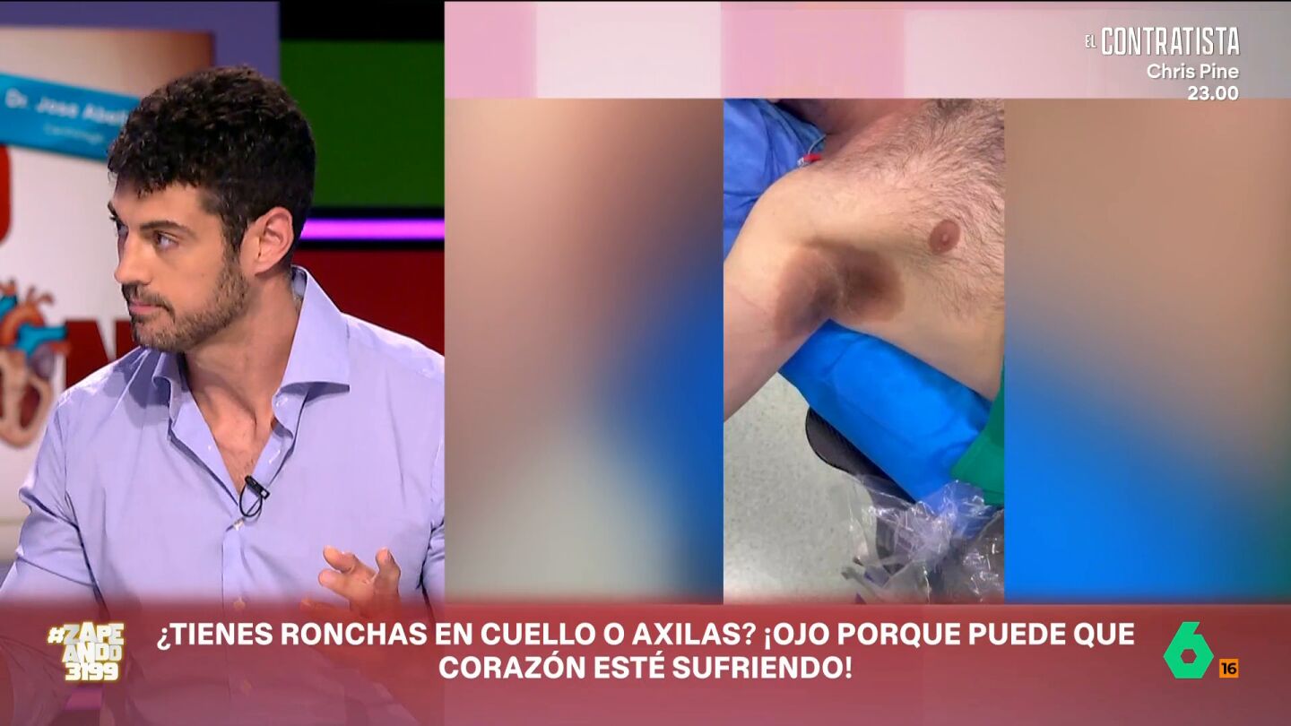 Jos&eacute; Abell&aacute;n, cardi&oacute;logo, habla en Zapeando de casos curiosos que encuentra en su consulta, como un paciente que acud&iacute;a con manchas en cuello y axilas. Se trata de acantosis nigricans, una dolencia que dice que "nuestro metabolismo est&aacute; sufriendo" y que puede ocultar una enfermedad card&iacute;aca.