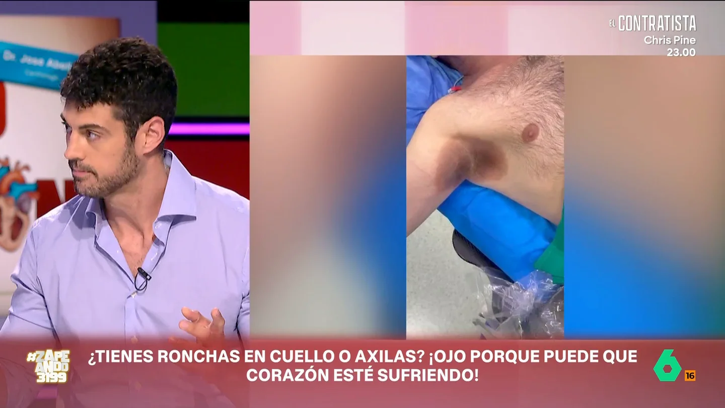El cardiólogo José Abellán advierte sobre las manchas negras en cuello y axilas: "Su corazón puede presentar un problema" José Abellán, cardiólogo, habla en Zapeando de casos curiosos que encuentra en su consulta, como un paciente que acudía con manchas en cuello y axilas. Se trata de acantosis nigricans, una dolencia que dice que "nuestro metabolismo está sufriendo" y que puede ocultar una enfermedad cardíaca.