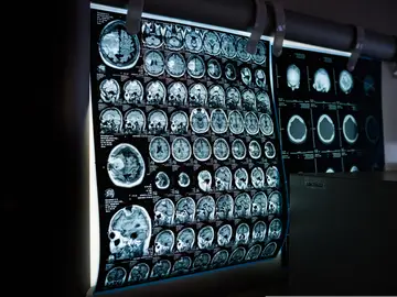 Resonancia cerebral Resonancia cerebral