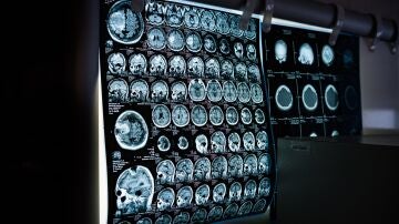 Resonancia cerebral