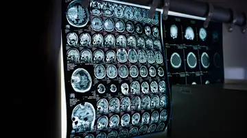 Resonancia cerebral Resonancia cerebral