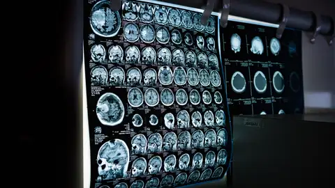 Resonancia cerebral Resonancia cerebral