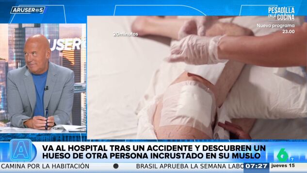 Alfonso Ar&uacute;s alucina con la mujer que ten&iacute;a un hueso de otra persona incrustado en el muslo tras sufrir un accidente