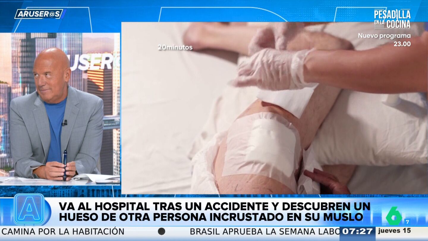 Alfonso Ar&uacute;s alucina con la mujer que ten&iacute;a un hueso de otra persona incrustado en el muslo tras sufrir un accidente