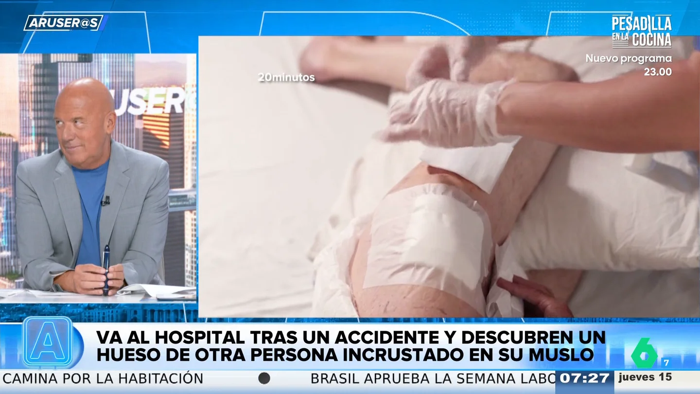 Alfonso Arús alucina con la mujer que tenía un hueso de otra persona incrustado en el muslo tras sufrir un accidente Alfonso Arús alucina con la mujer que tenía un hueso de otra persona incrustado en el muslo tras sufrir un accidente