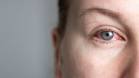 Una mujer con el ojo rojo