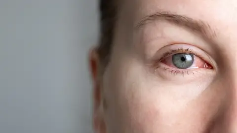 Una mujer con el ojo rojo Una mujer con el ojo rojo