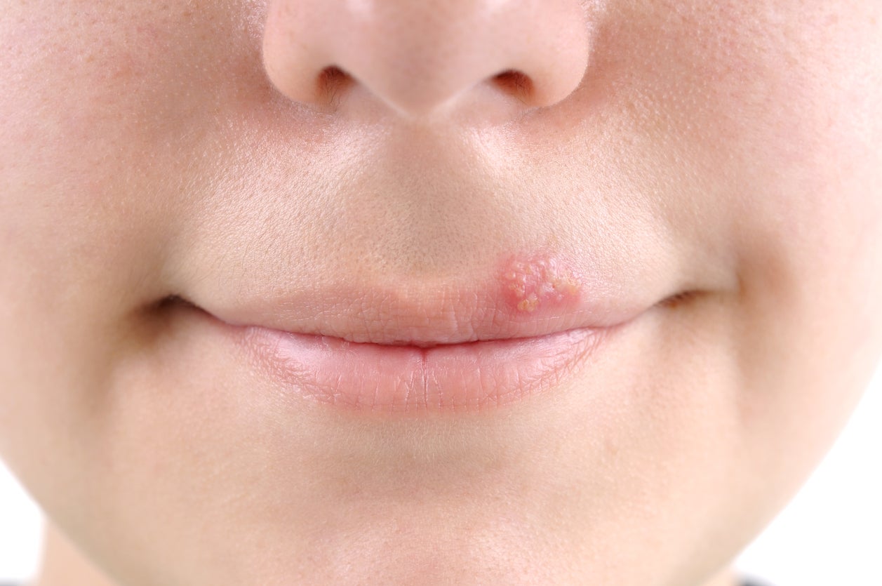 A genitales herpes labial pasar puede