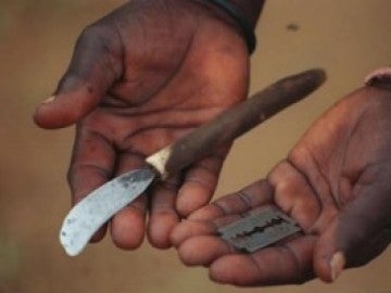 Cuchillas de afeitar, navajas o trozos de vidrio se emplean para realizar la ablación. Cuchillas de afeitar, navajas o trozos de vidrio se emplean para realizar la ablación.